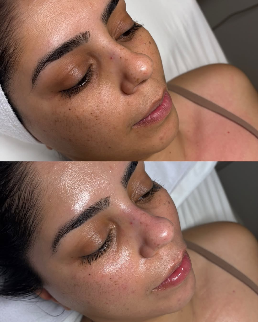 HydraFacial Treatment at Kedirose Beauty & Aesthetic Clinic, Kempton Park