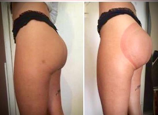Non-surgical butt lift before and after results at Kedirose Beauty Clinic Kempton Park