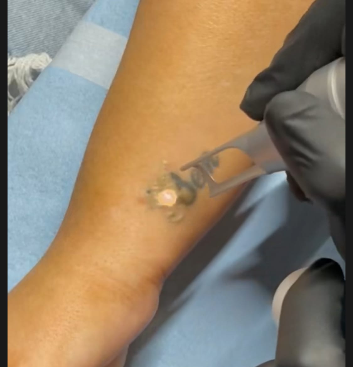 Tattoo Removal at Kedirose Beauty Clinic Kempton Park