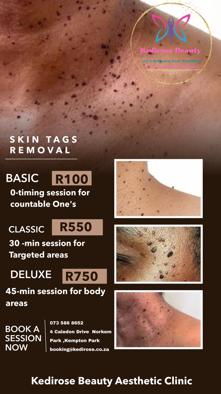 Skin tag removal treatment at Kedirose Beauty Clinic Kempton Park